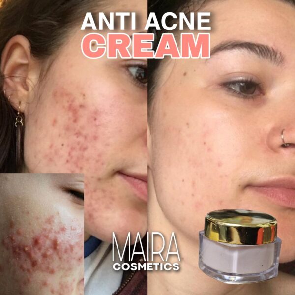 ANTI ACNE CREAM 30gm